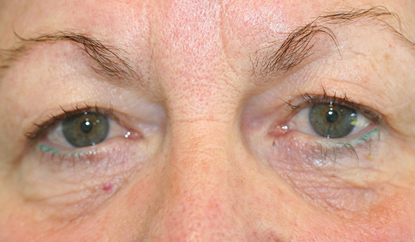 Eyelid reduction surgery (Blepharoplasty)