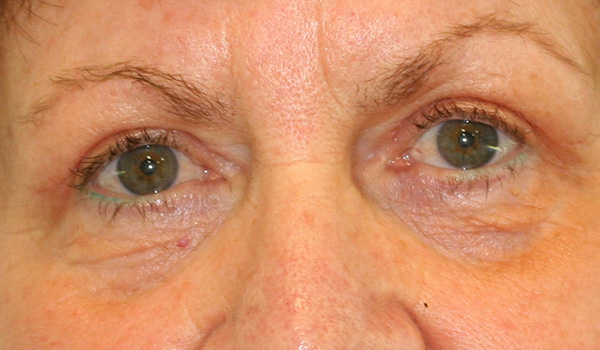 Eyelid reduction surgery (Blepharoplasty)