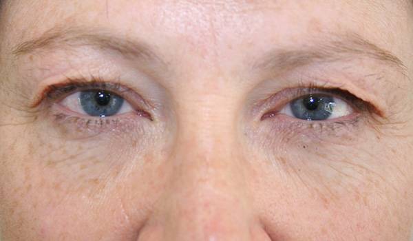 Eyelid reduction surgery (Blepharoplasty)