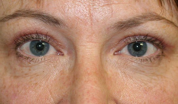 Eyelid reduction surgery (Blepharoplasty)