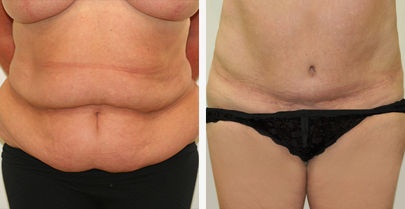 Tummy Tuck (Abdominoplasty)
