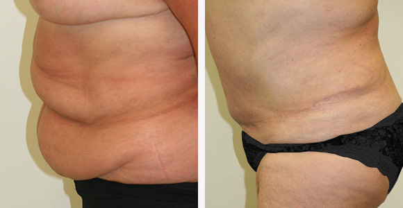 Tummy Tuck (Abdominoplasty)