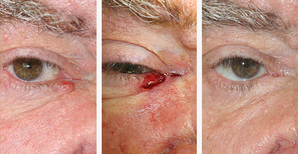 Skin Cancer Surgery