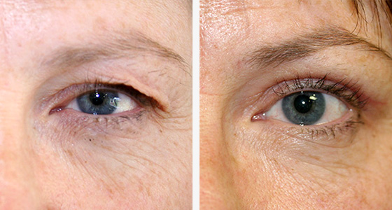Eyelid reduction surgery (Blepharoplasty)