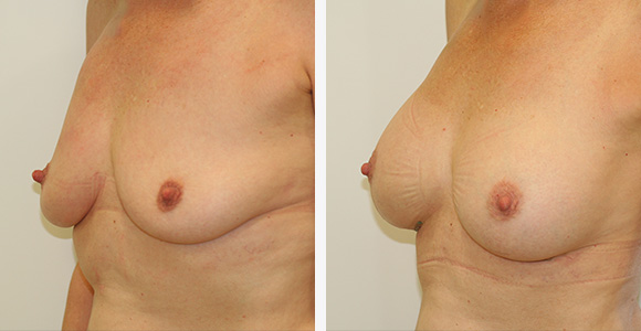 Breast Enlargement
