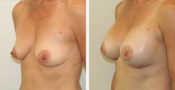 Breast Enlargement