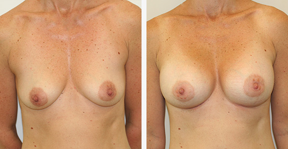 Breast Enlargement