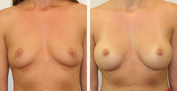 Breast Enlargement
