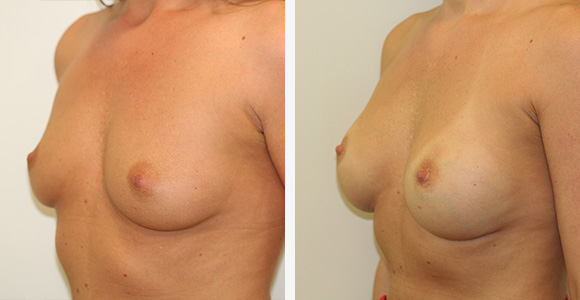 Breast Enlargement