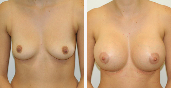 Breast Enlargement