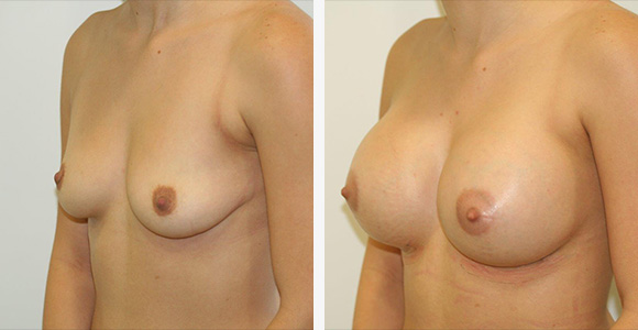Breast Enlargement