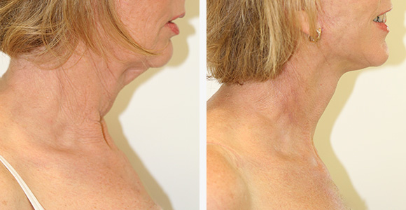 Face Lift / MACS Lift