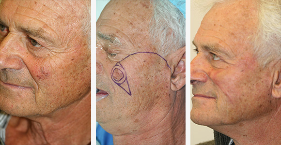 Skin Cancer Surgery