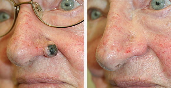 Skin Cancer Surgery