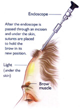 Browlift2